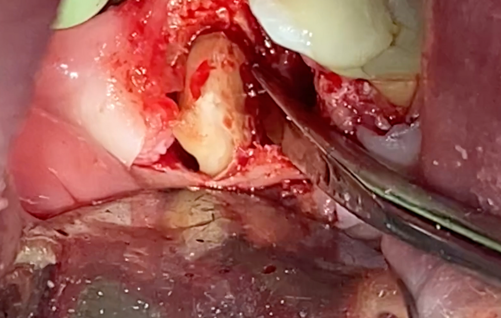 THE Extraction Course – The Extraction Course